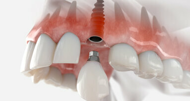 Researchers in Australia seek to improve dental implant outcomes