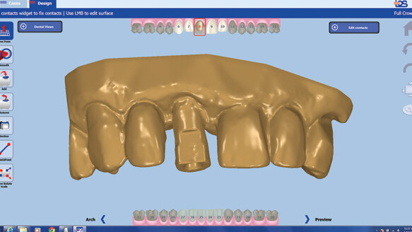 Two-day custom abutments and crowns from intraoral scans