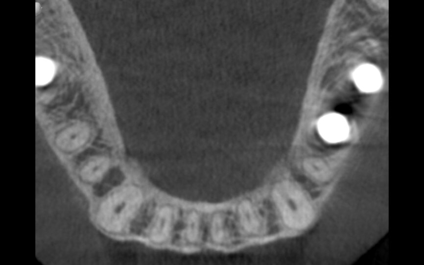 Fig.12a: The two-year follow-up post-op CBCT scan.