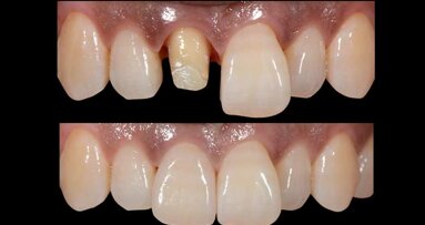 Rehabilitación estética de un diente anterior