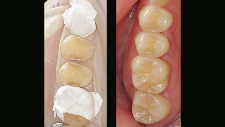 Figure 15: Ceramic partial crowns seated with the adhesive technique
