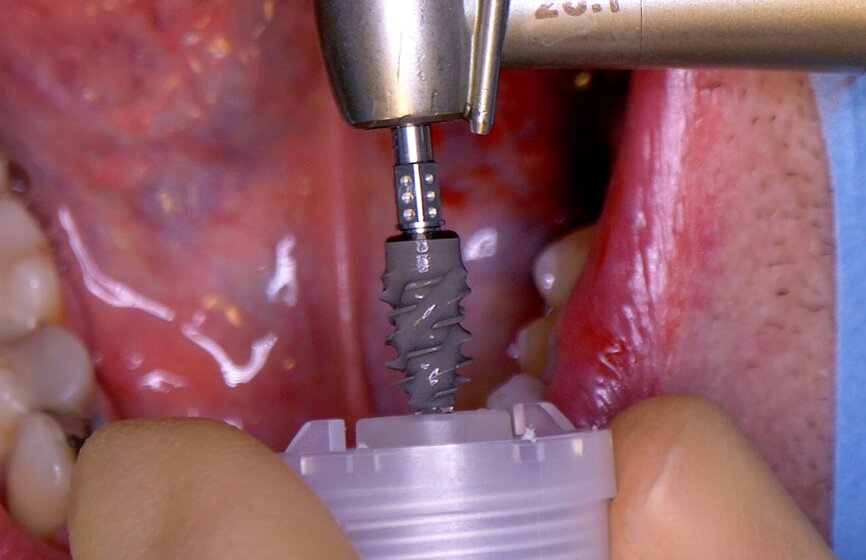 Fig. 3: Implant being removed from the vial cap for insertion into the osteotomy.