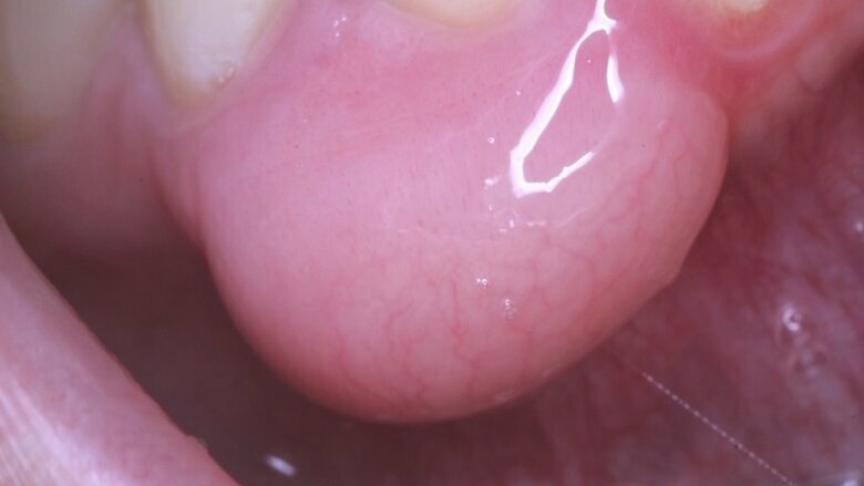 La importancia de la biopsia en la mucinosis focal oral