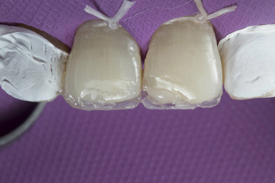 Fig. 9: Build-up of deep dentin with Shofu Beautifil II LS A20, note the different amount placed in each tooth