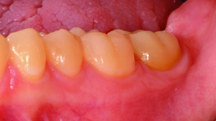 Fig. 16: Beautifully healed gingiva after three months.