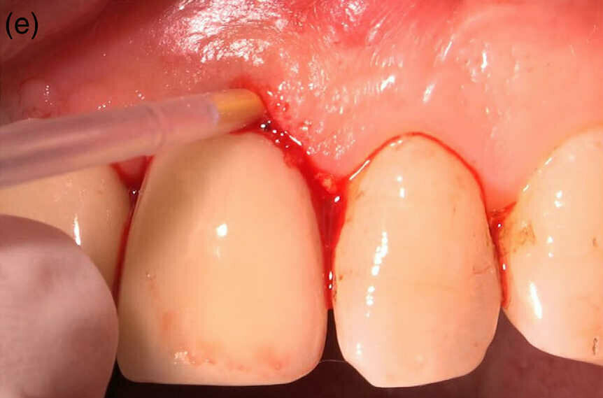 Fig 1 (e) Injection de 1 mg de microsphères de chlorhydrate de minocycline dans le sillon gingivo-dentaire.