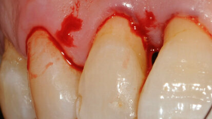 L’applicazione del protocollo  Clean&Seal nel trattamento delle  tasche parodontoli: un case report