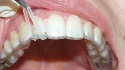 Stop asking aligners to do things they are not good at!
