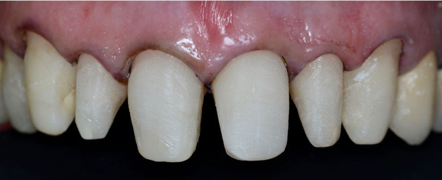 Fig. 3 - Preparazioni dentali.