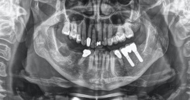 Tratamiento preventivo en paciente sana con enfermedad periodontal