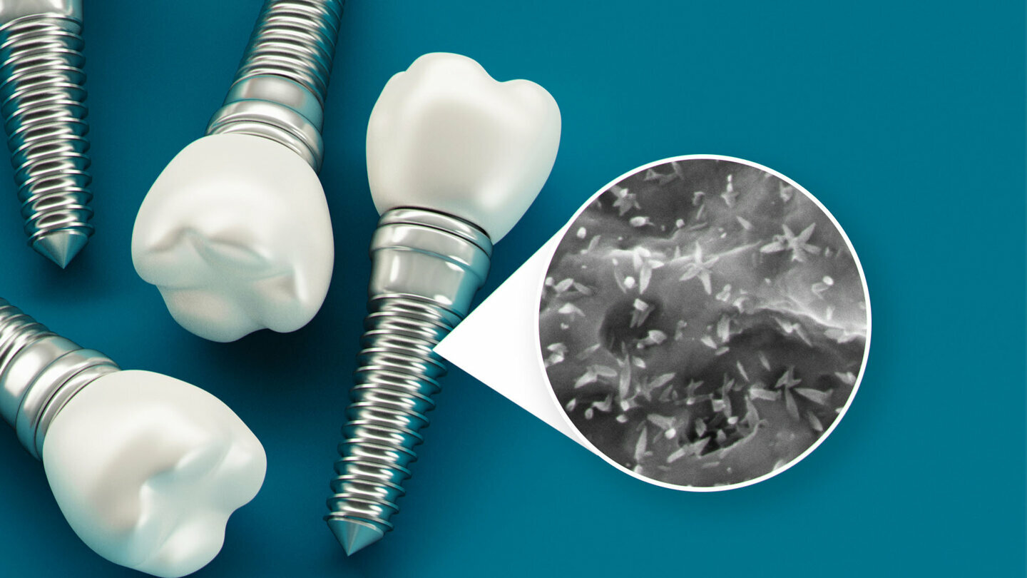 Nanotechnology advances dental implant surfaces