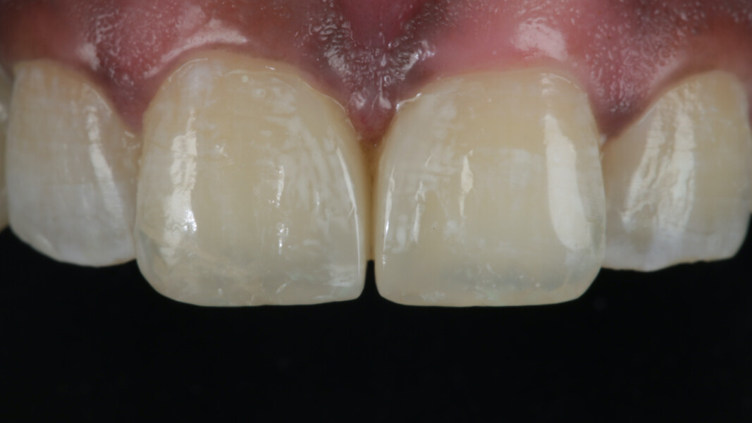 Fig 23. Post-op 7 Days shows the smooth finish and polish which integrated well with the surrounding soft tissues. The healthy papilla filled the interdental space leaving no black triangle.