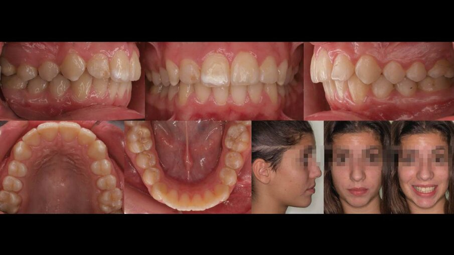 Fig. 4 - Caso a fine cura. La terapia ortodontica è durata complessivamente 22 mesi. Il miglioramento del profilo è l’aspetto più significativo e rilevante del trattamento.