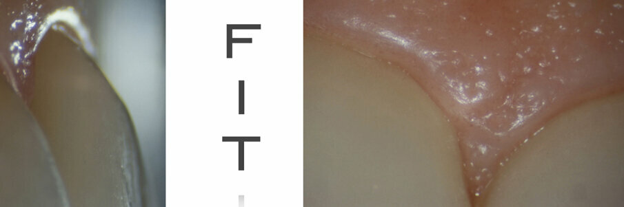 Figg. 25, 26 - Precisione marginale in bocca.