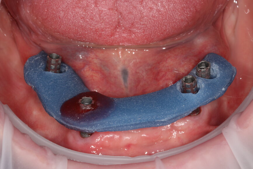 Fig. 15: Verification jig locked in situ to gain implant passivity.