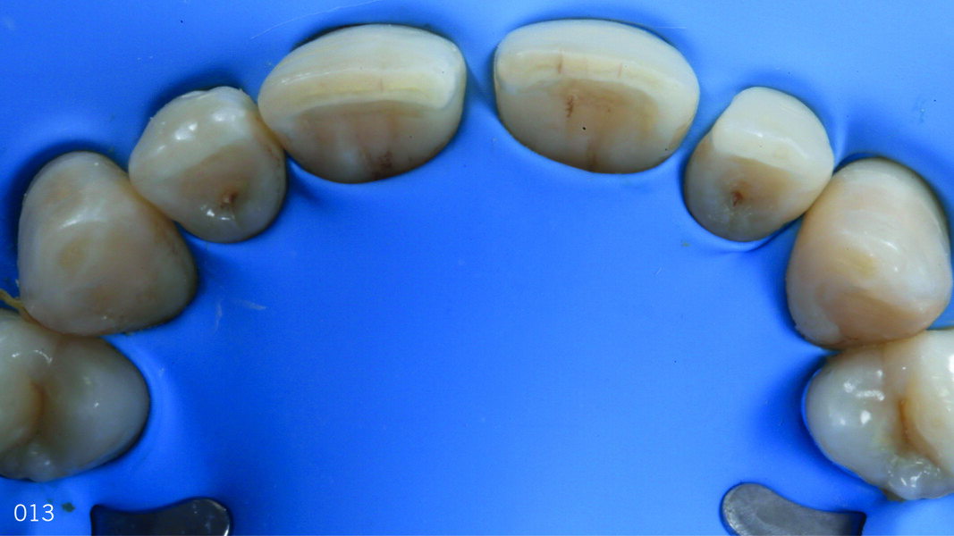 Fig. 12: Isolation of the operative field using a dental dam, occlusal view