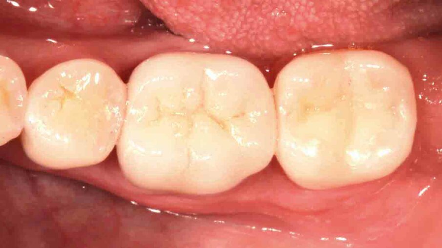 Fig. 10: Situation after crown placement, removal of the excess cement and thorough cleaning. The crown blends in nicely with the surrounding tooth structure.