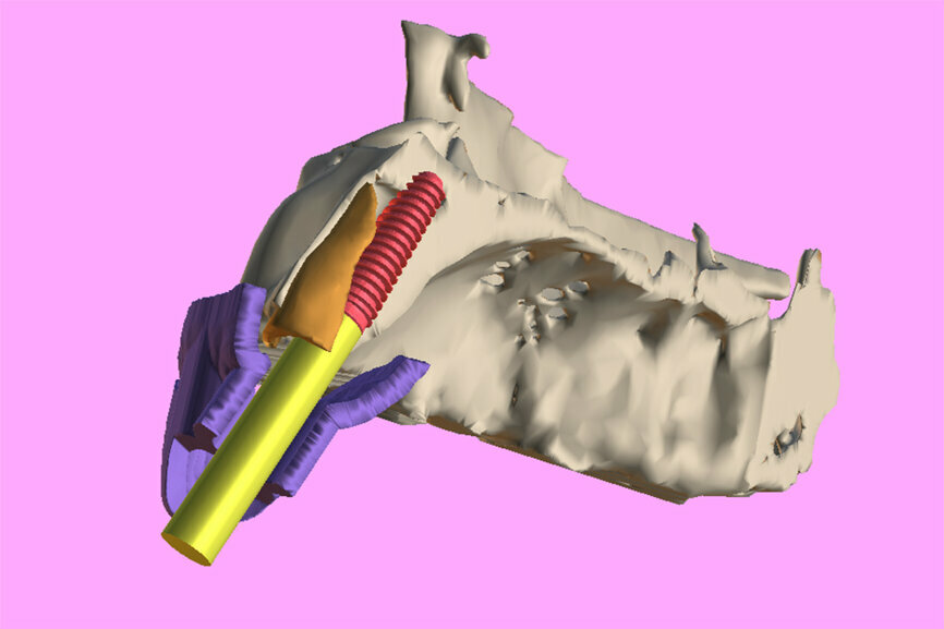Fig. 5b: The apical portion of the simulated AnyRidge implant can then be positioned so as not to touch the root fragment while engaging in host bone for stability.