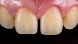 Fig. 1. Situación de partida: paciente joven con diastema entre los dientes 11 y 21.