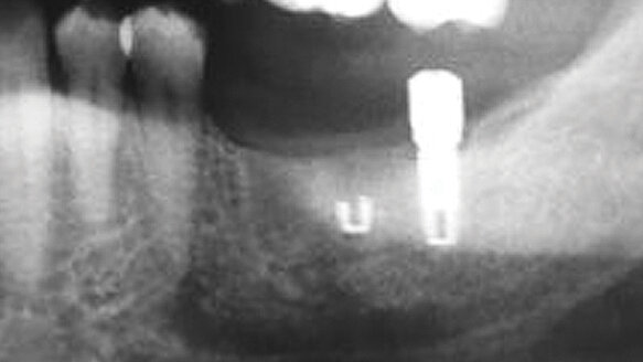 Intro to CBCT as it pertains to prevention of failures in oral implantology