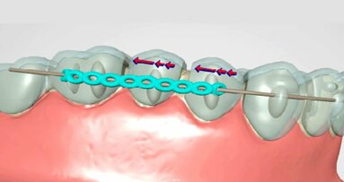 The new NimrodAligner: From straightforward to complex cases