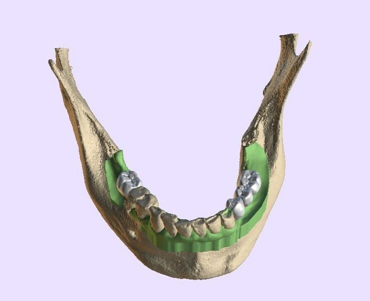 Fig. 6c: STL surface model merged with DICOM data with virtual posterior teeth.