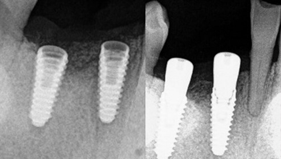 Figs. 14a & b: Periapical radiographs of the implant placement (a) and healing abutments placed (b).
