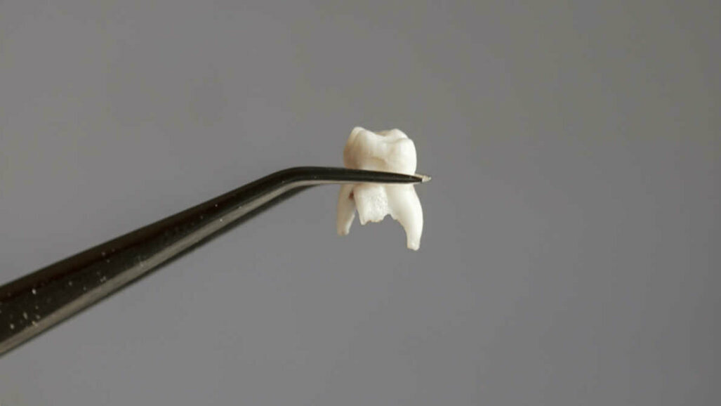 Алгоритмы машинного обучения могут помочь прогнозировать утрату зубов