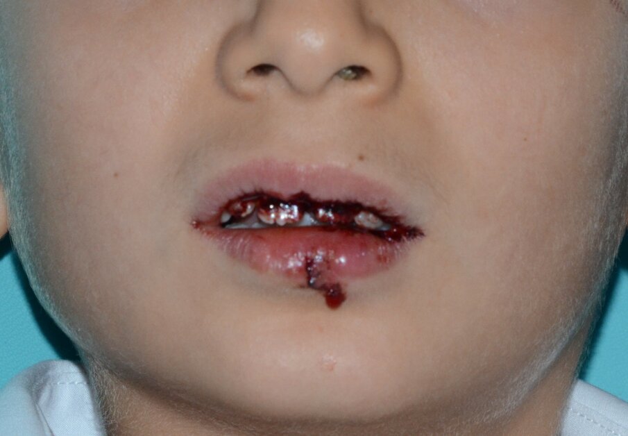 Figure 10a: The clinical appearance following a second trauma incident that happened within two hours of  fitting the dental splint.