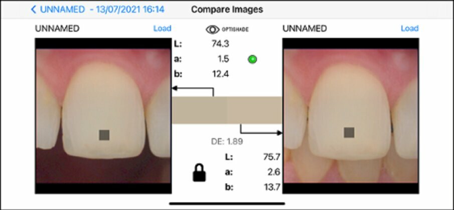 Fig. 11d: Same tooth, same surface (clean), same time frame, same positioning, same device, *different background. Shade difference: 1.89. Unreliable measurement. The asterisk indicates the parameter critical to the reliability of the measurement.