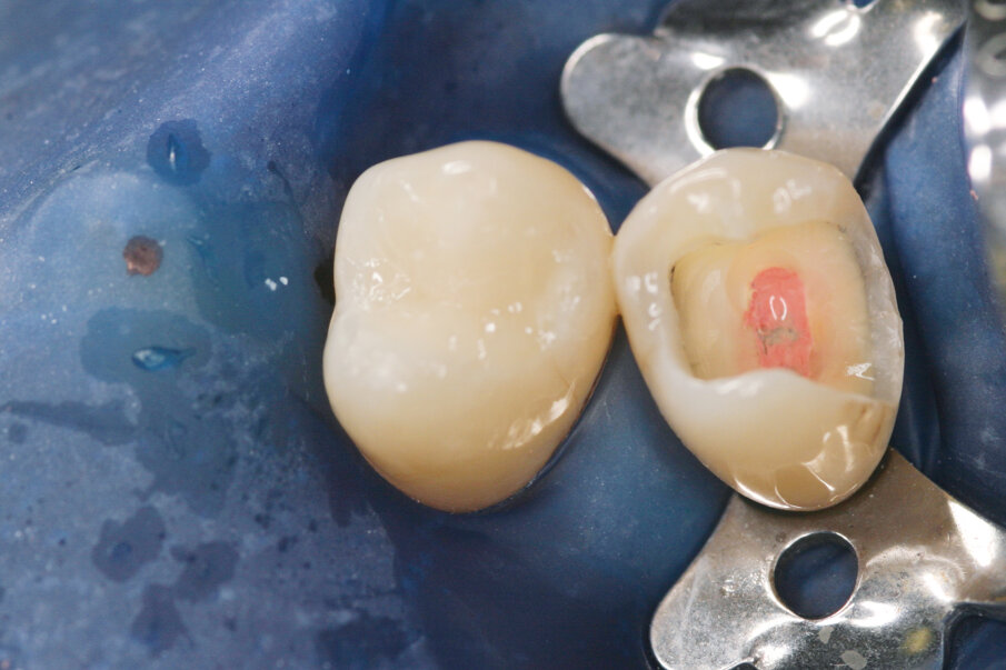 Fig: 6. Occlusal surface was restored with the universal composite ceram.x® SphereTEC™ one.