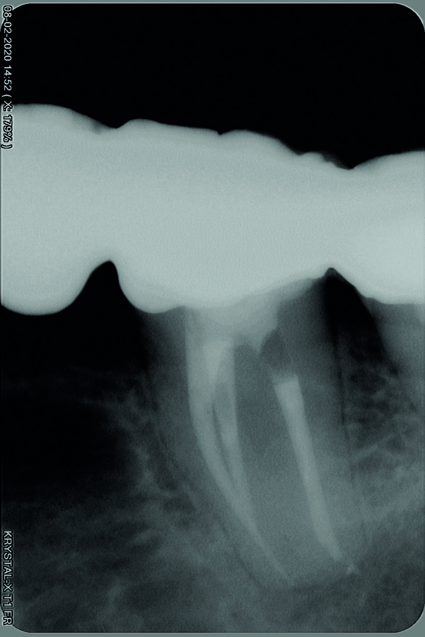 Fig. 17 : Radiographie prise lors du suivi à neuf mois.