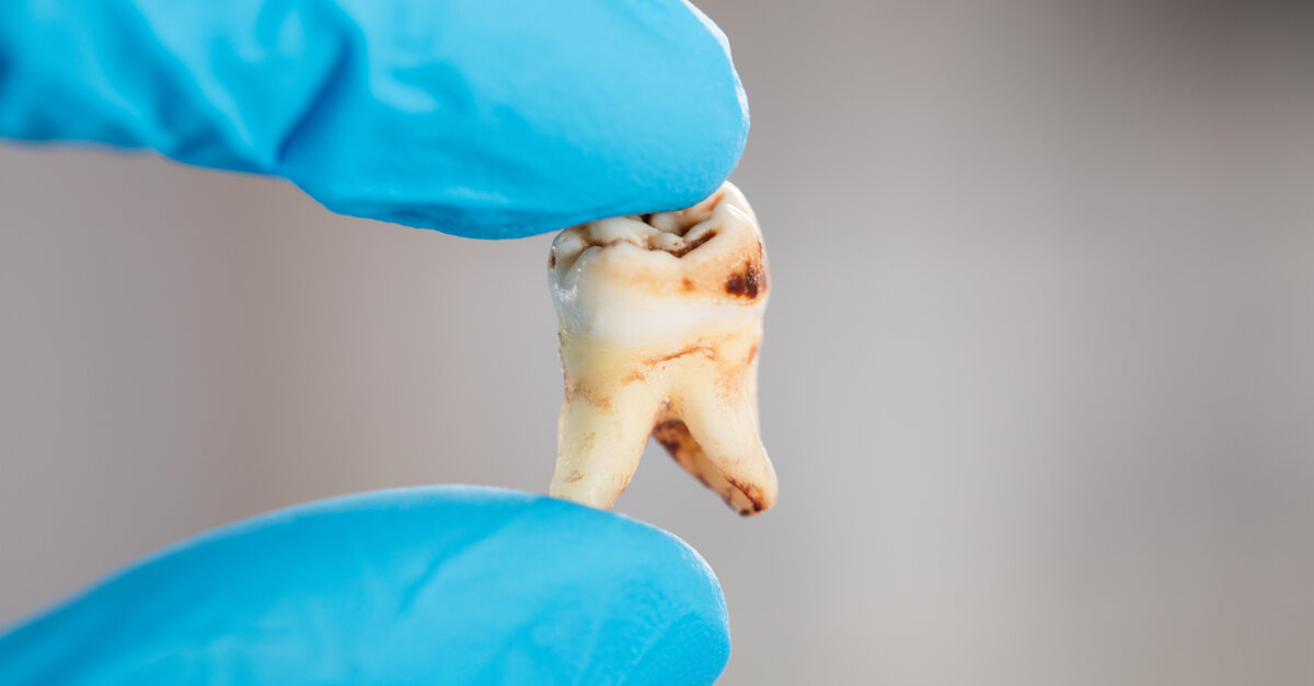 New study on dental caries prevention Patientparadise