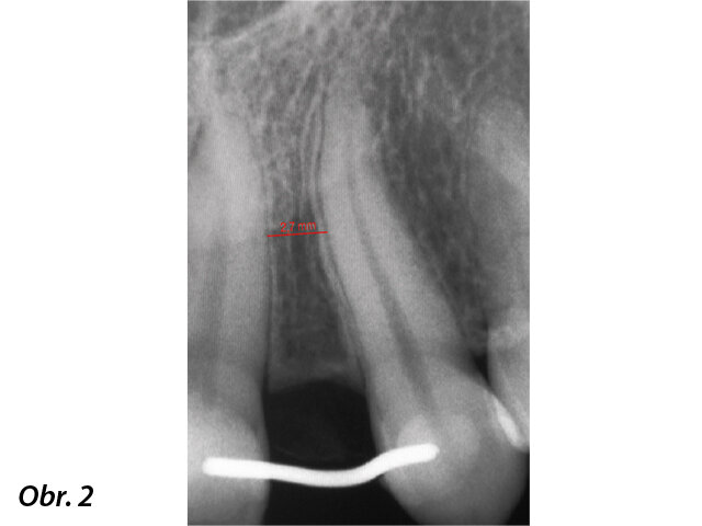 Periapikální RTG snímek vrozeně chybějícího horního levého postranního řezáku. Aproximální prostor mezi zubem 21 a zubem 23 zůstal kritický i po ortodontické léčbě.