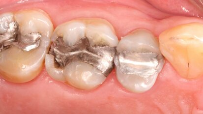 Weitere Einschränkung zum Einsatz von Amalgam in der Zahnmedizin