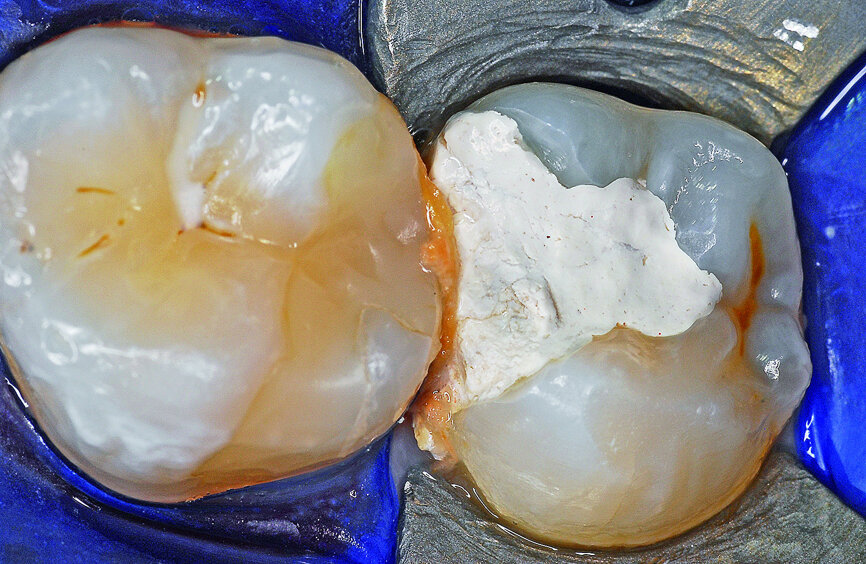 Fig. 2: Preoperative view of the maxillary second left molar temporarily restored with IRM. Note the food impaction between the first and second molar teeth.