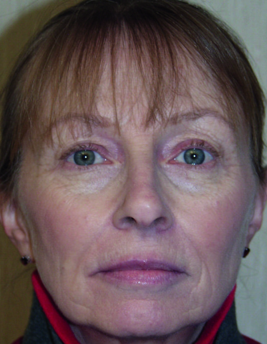 Prétraitement facial, post-traitement facial six mois et neuf mois après, et enfin, évaluation morphométrique du changement.