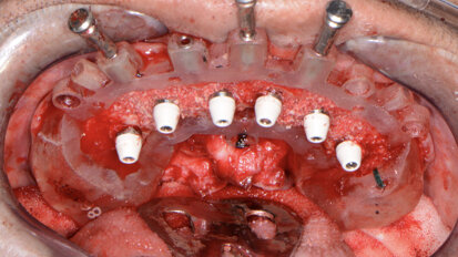 Predictable guided implant placement for full-mouth reconstruction