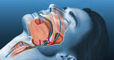 Novel application of jaw advancement surgery helps treat OSA and improves facial appearance