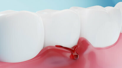 研究使用人工智能来检测牙龈炎