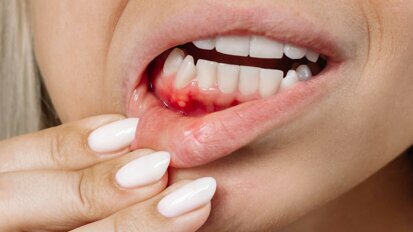 Parodontitis: Mundgesundheit von rund 35 Millionen betroffen