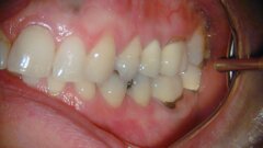 Een 37-jarige follow-up van een endodontisch behandeld element met een perforatie