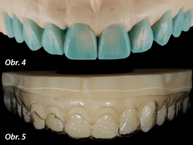 Obr. 4: Wax-up na sádrovém modelu vztahující se k rekonstrukci deseti předních zubů. Obr. 5: 3D tištěný model dle digital smile design plánování nesoucí mock-up formu. Cervikální otvor byl vytvořen kvůli chirurgickému přístupu a vedení při prodlužování korunek.
