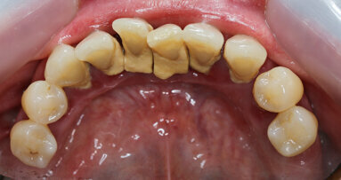 Gum disease and systemic health