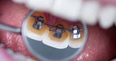 Neuentwicklung zur Säuberung von Zahnspangen