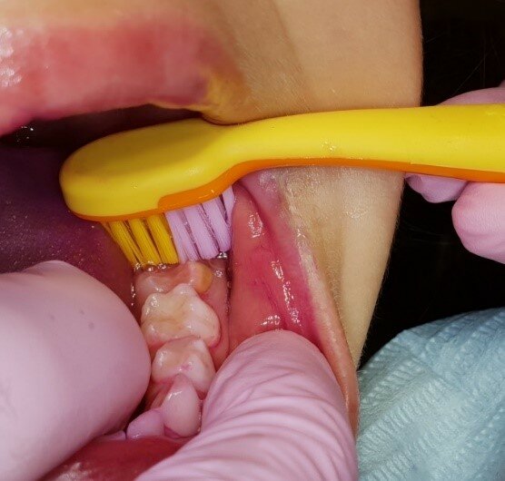 Afbeelding 6: Dwars door de tandboog poetsen van de doorkomende blijvende molaren bij een andere patiënt.