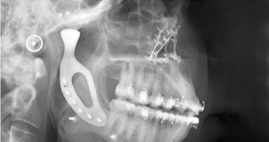 Chirurgen plaatsen 3D-geprint titanium kaakgewricht