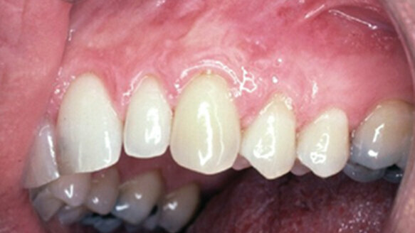 Cosmetic periodontal surgery: Barriers of success