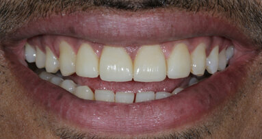 Designing smiles and Changing lives with Porcelain Laminate Veneers