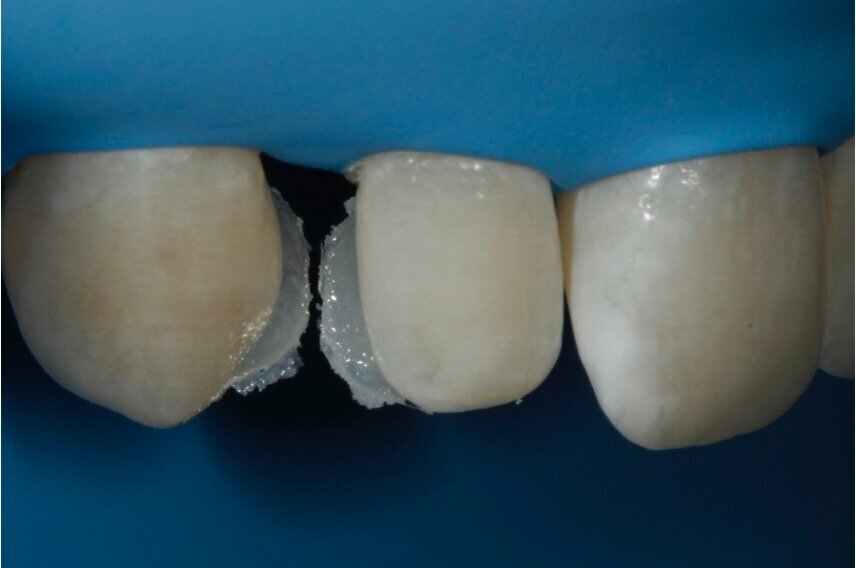 Fig. 1: Common troubles with wax-up based techniques, the apical part of the palatal wall is defective. 